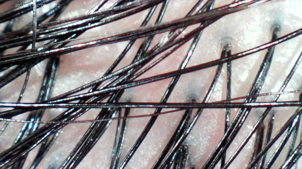 After Pre-scalp prep treatment