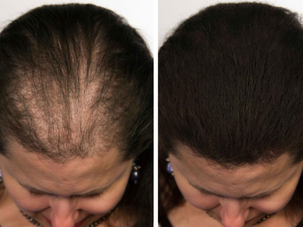 Xtreme Growth Therapy