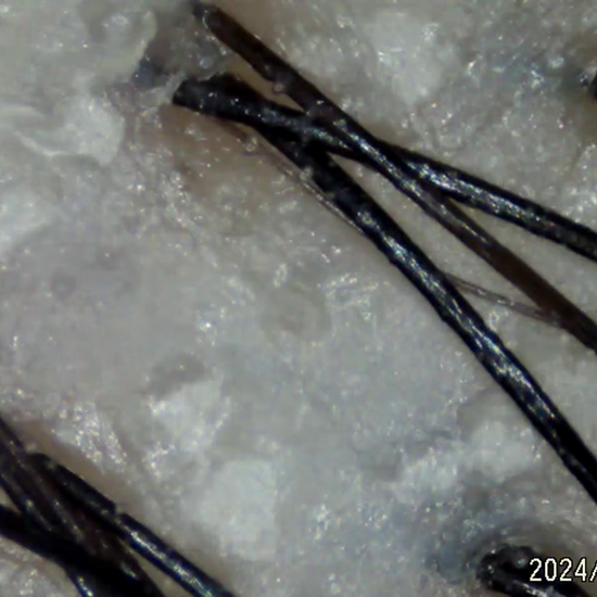 under microscope after the scalp prep
