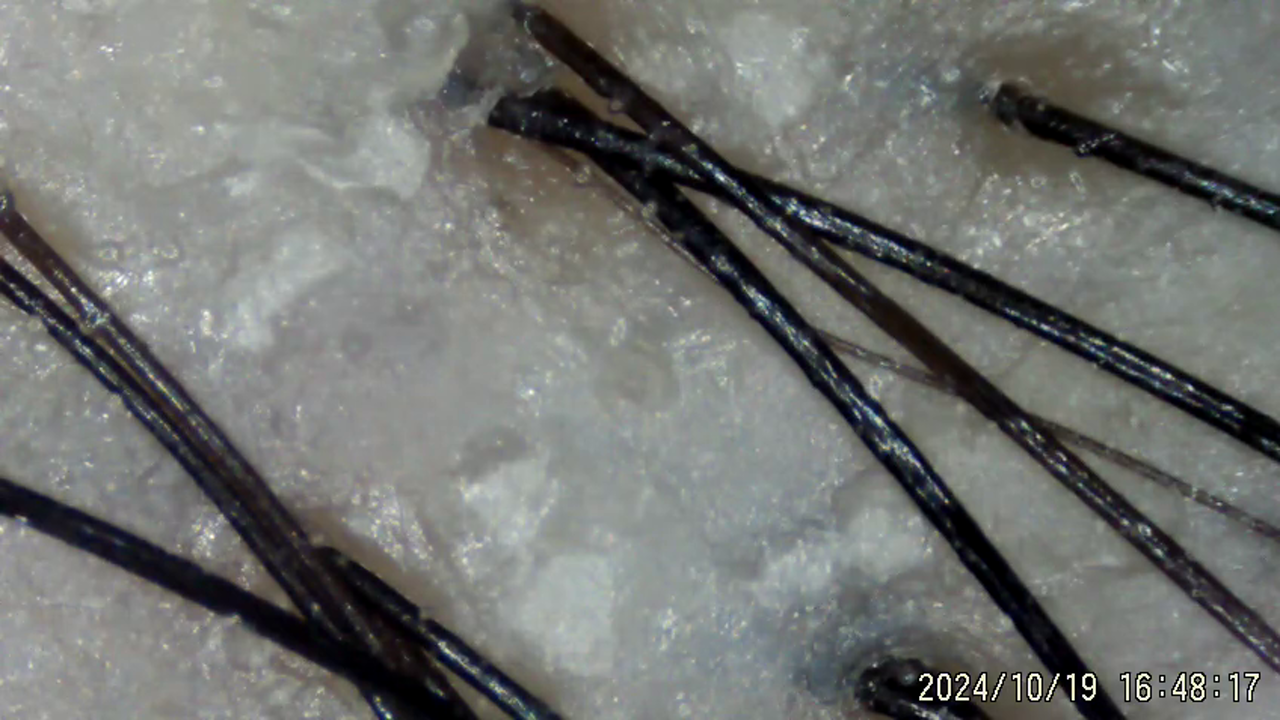 under microscope after the scalp prep